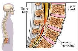 Management of lumbar spinal stenosis: State of the Art | Comprehensive Geriatric Assessment | Scoop.it