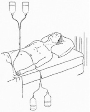 The unsung story of early peritoneal dialysis | Peritoneal dialysis | Scoop.it