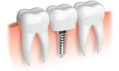 The Superiority of Dental Implants Over Dentures | My Affordable Dentist Near Me | Scoop.it