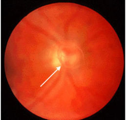 MEDICINA INTERNA: ANORMALIDADES DEL FONDO DE OJO | Salud Visual 2.0 | Scoop.it