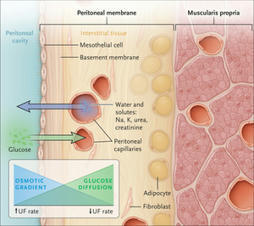 Peritoneal Dialysis | Peritoneal dialysis | Scoop.it