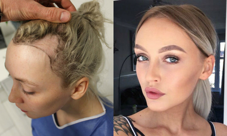 Draag je altijd een te strakke knot? Dit meisje kreeg extreme haaruitval - Beautify | Informatie over haar | Scoop.it