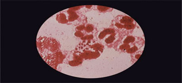CDC Warns Untreatable Gonorrhea Is on the Way | Virology News | Scoop.it