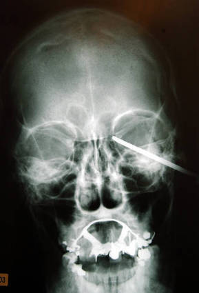 X-Ray Shows Knife Stuck in Head After Brawl | Strange days indeed... | Scoop.it