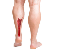 Achilles Tendonitis Exercises | Sports Injuries | Scoop.it