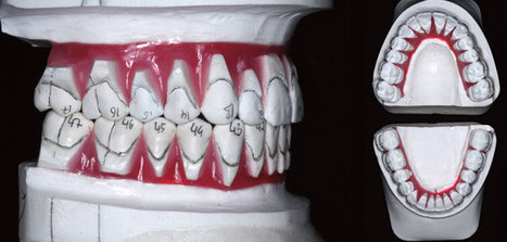 Le set-up numérique la révolution de l’orthodontie digitale | Buzz e-sante | Scoop.it