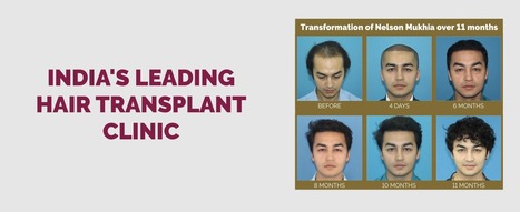 Best Hair Transplant In Mumbai In Best Hair Transplant Clinic In