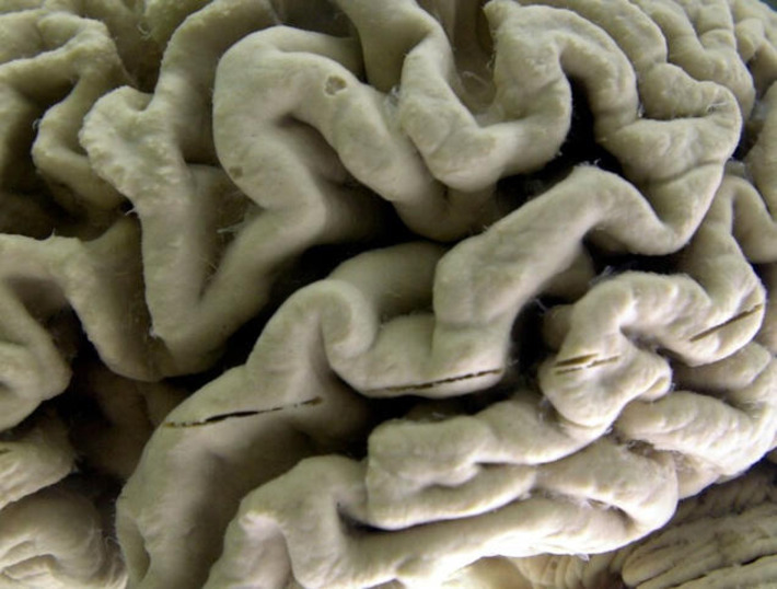 Research links blood test results to early Alzheimer&rsquo;s | The Health Report | Scoop.it