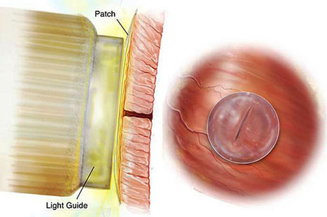 Bio-inspired glue keeps hearts securely sealed | 21st Century Innovative Technologies and Developments as also discoveries, curiosity ( insolite)... | Scoop.it