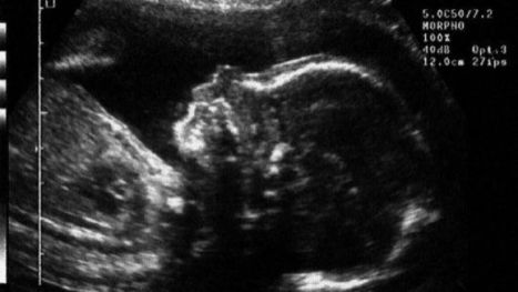 Belgique - Avortement : allonger les délais, une solution ? | Koter Info - La Gazette de LLN-WSL-UCL | Scoop.it