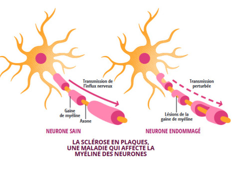 Scl&eacute;rose en plaques : La recherche ouvre de nouvelles voies | Life Sciences Universit&eacute; Paris-Saclay | Scoop.it
