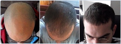 Турецкая пересадка волос. Прически после пересадки волос. Пересадка волос в Турции. Трансплантация волос в Турции.