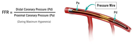 Fractional Flow Reserve | Interventional Cardiology | Scoop.it