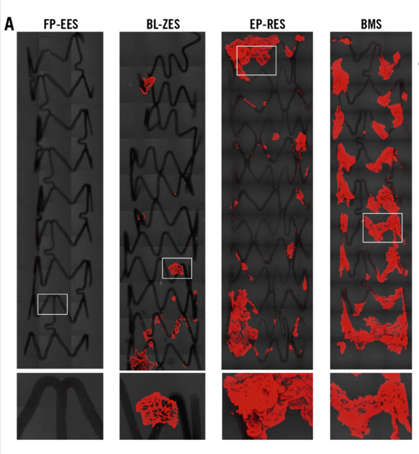 Comparison of acute thrombogenicity and albumin adsorption in three different durable polymer coronary drug-eluting stents | Interventional Cardiology | Scoop.it