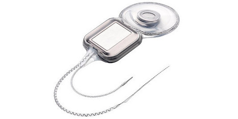 L'implant CI522 de Cochlear sur la liste des produits remboursés | Revue de presse Implant Cochléaire | Scoop.it