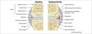 Recent advances in intra-articular drug delivery systems for osteoarthritis therapy - ScienceDirect | Rheumatology-Rhumatologie | Scoop.it