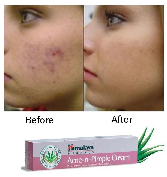 effect-of-himalaya-acne-n-pimple-cream-best-b