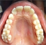 Supernumerary Teeth | News | Dentagama | Daily Magazine | Scoop.it