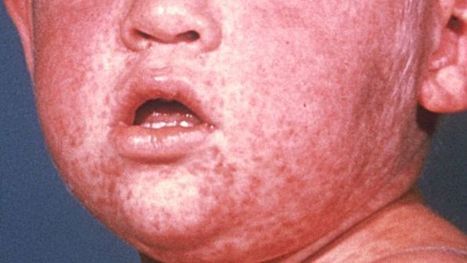 Samoa declares state of emergency as measles outbreak claims lives - ABC News (Australian Broadcasting Corporation) | GTAV AC:G Y10 - Geographies of human wellbeing | Scoop.it