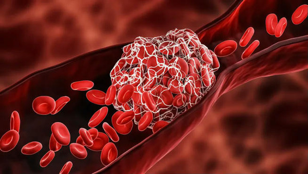 Route 92 Medical raises $50M to fund global sales of stroke devices | Neurovascular Intervention | Scoop.it