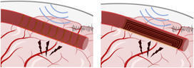 Toward a fully wireless endovascular neural interface: Evaluating power transfer efficacy | Brain Computer Interfaces & connected medical devices | Scoop.it