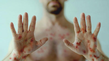 CDC Warns of Severe Monkeypox Disease in People With HIV Who Are Immunocompromised | Amazing Science | Scoop.it