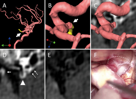 Working Status in Patients With Untreated Unruptured Intracranial Aneurysms | Neurovascular Intervention | Scoop.it
