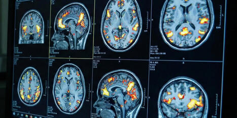 Brain scans reveal a universal neural signature for addiction | Substance Abuse | Scoop.it