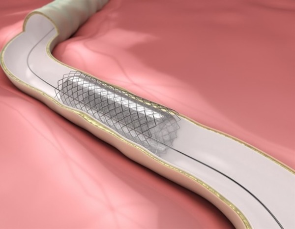 Landmark trial shows drug-eluting balloon as effective option for in-stent restenosis | Interventional Cardiology | Scoop.it