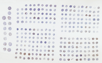 Researchers Identify Biomarker in Helping Curtail PAH Caused By Scleroderma ... - Pulmonary Hypertension News | AUTOIMMUNITY | Scoop.it