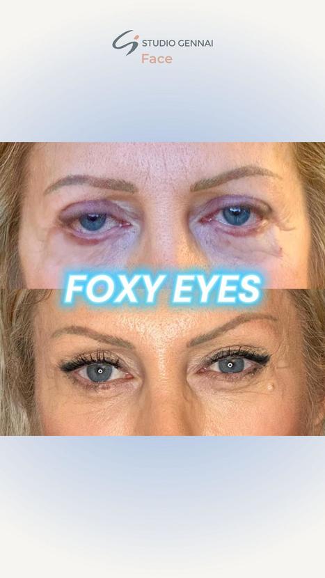Perché Scegliere gli Foxy Eyes? | Dr. Alessandro Gennai | Medicina Estetica News | Scoop.it