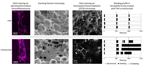 Structures des caillots en fonction du traitement dans l'hémophilie A | Life Sciences Université Paris-Saclay | Scoop.it