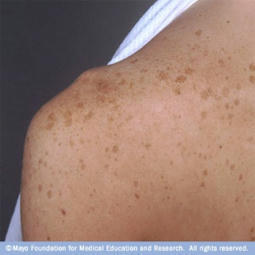 Preventing Sun Spots | Navigating Healthcare | Medical and Health | Scoop.it