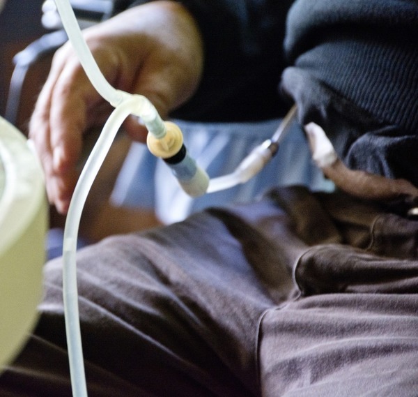 Peritoneal Dialysis-Associated Infection Rates Vary by Country | Peritoneal dialysis | Scoop.it