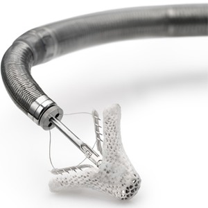 MitraClip Minimally Invasive Mitral Valve Repair System Finally Approved in U.S. | Transcatheter Treatment of Mitral Regurgitation | Scoop.it