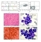 Mast Cell Leukaemia: c-KIT Mutations Are Not Always Positive | Hematology | Scoop.it
