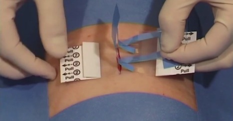 Ohne Nadel und Faden: Mit neuer Methode können Wunden ganz einfach behandelt werden - Video | #Health #Medicine  | 21st Century Innovative Technologies and Developments as also discoveries, curiosity ( insolite)... | Scoop.it