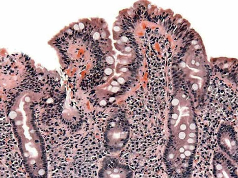 Risk of Celiac Disease, Type 1 Diabetes, and Thyroid Disease Autoimmunity During the SARS-CoV-2 Pandemic in South of Sweden | Virus World | Scoop.it