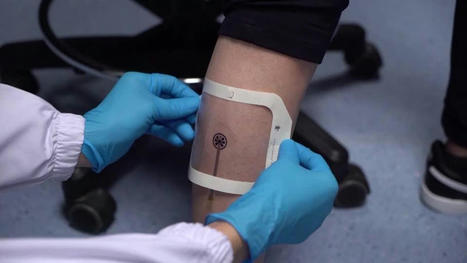 Singapore smart bandage monitors wounds using app | Daily Beats | Scoop.it