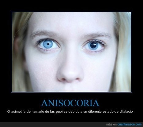 ANISOCORIA | Salud Visual 2.0 | Scoop.it