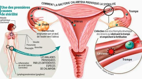 Chlamydia, une IST silencieuse qui peut rendre les femmes st&eacute;riles&nbsp; | sida | Scoop.it