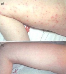 Molluscum contagiosum : un traitement à base d’huile essentielle de Tea-Tree | Aromathologie | Scoop.it