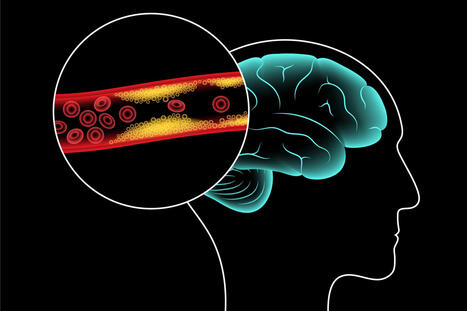 T&auml;m&auml; lis&auml;&auml; &auml;kkikuoleman riski&auml;, kun aivoverenvuoto alkaa | 1Uutiset - Lukemisen t&auml;hden | Scoop.it