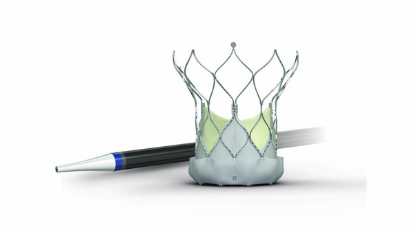Abbott launches its largest Navitor Vision valve size in UK | Transcatheter Treatment of Mitral Regurgitation | Scoop.it