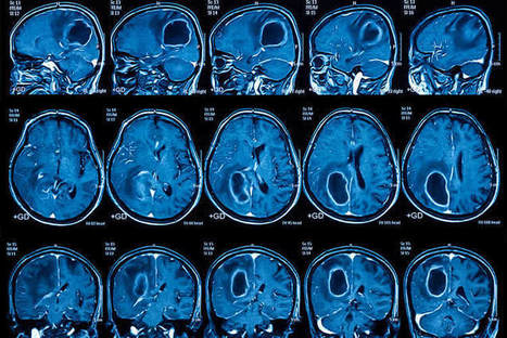 Brain Cancer Vaccine Effective in Some Patients | Virology News | Scoop.it