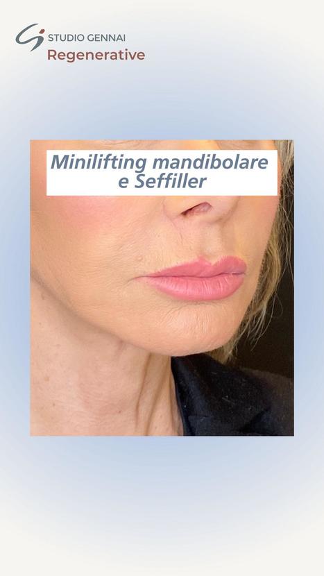 Minilifting mandibolare e seffiller | Dr. Alessandro Gennai | Medicina Estetica News | Scoop.it