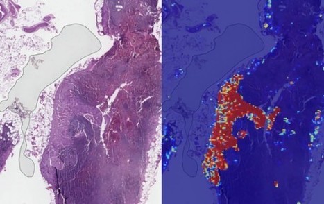 IA : Google détecte le cancer du sein avec une précision de 99% | e-sante | Scoop.it