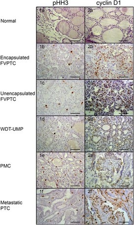 An Appraisal of Proliferation and Apoptotic Markers in Papillary Thyroid Carcinoma: An Automated Analysis | Social marketing - Health Promotion | Scoop.it