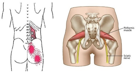 The Hidden Muscle Causing Your Sciatica Pain And 5 Easy Stretches For INSTANT Relief | Sciatica "The Scourge & The Treatments" | Scoop.it