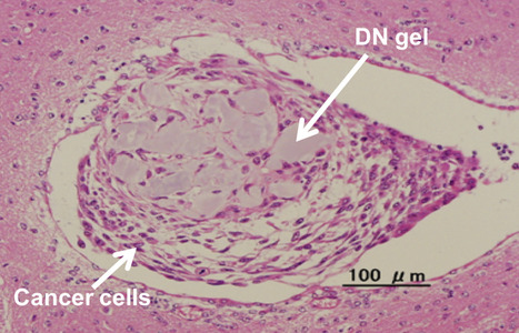 Uprooting cancer: Hydrogel rapidly reverts cancer cells back to cancer stem cells | Healthcare: reloaded... | Scoop.it